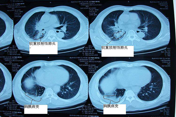 放射性肺炎是怎麼回事？放射性肺炎改怎麼辦？