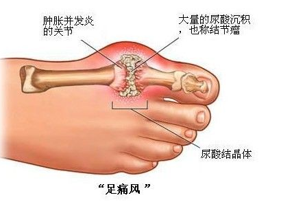 痛風如何快速消腫