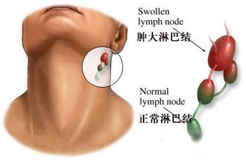 淋巴結核消腫貼有效嗎