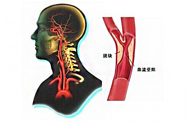 腦動脈硬化的癥狀 怎樣治療呢？