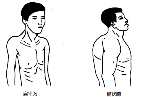 異常胸廓 胸廓不對稱是怎麼回事