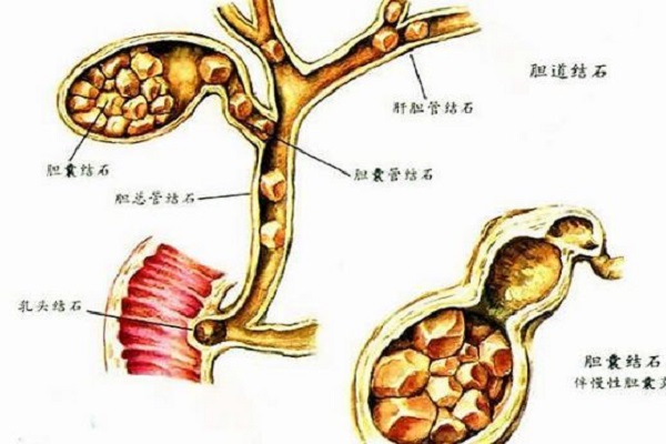 肝內膽管結石嚴重嗎?