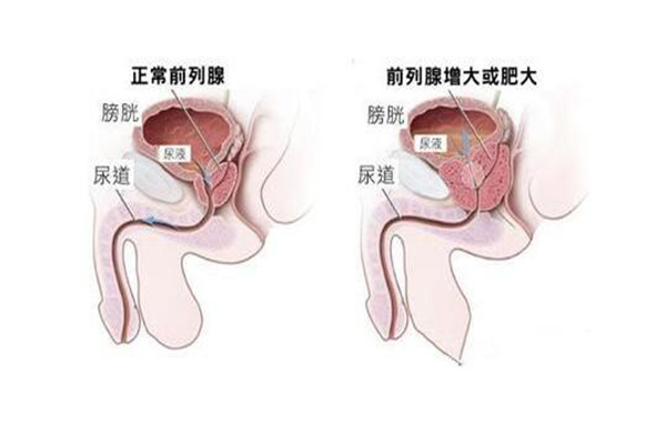 前列腺增生的癥狀_治療方法_前列腺增生怎麼治療