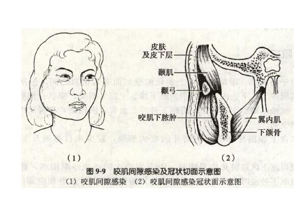 咬肌切除手術多少錢