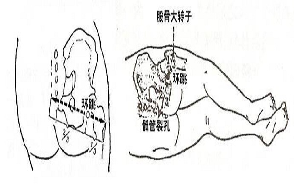 環跳穴位置及作用