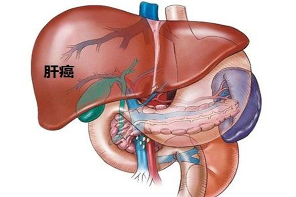 肝癌晚期有什麼癥狀_ 肝癌介入治療效果_預防肝癌_肝癌飲食