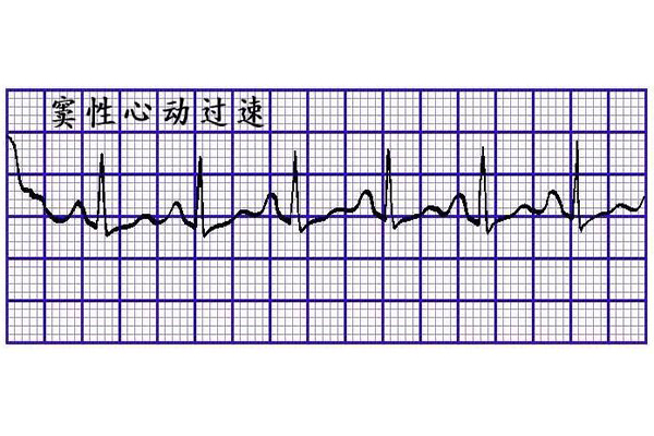 什麼是竇性心動過速_什麼叫竇性心動過速