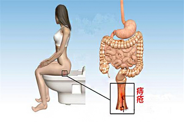 痔瘡是怎麼引起的_痔瘡出血怎麼辦_痔瘡手術後註意事項 