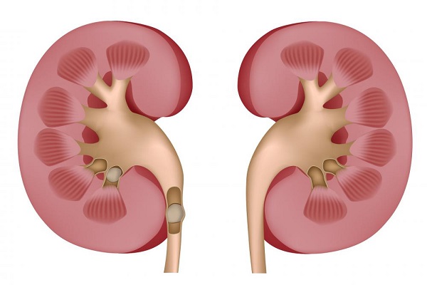 腎結石是怎麼形成的 腎結石不能吃的五類食物