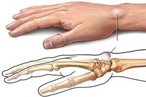 腱鞘囊腫是怎麼回事 腱鞘囊腫的治療方法