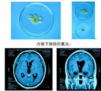 骨包囊蟲病怎麼治療