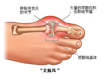 痛風如何快速消腫