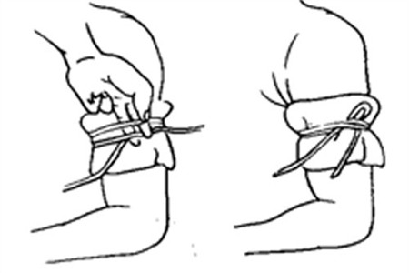 橡皮止血帶止血法 使用時應註意什麼