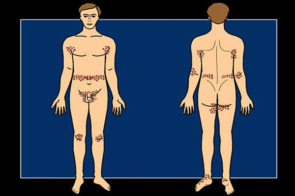 疥瘡癥狀_疥瘡結節的治療方法_怎麼治療_能根治嗎