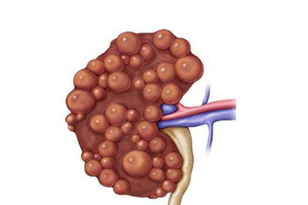 多囊腎能活多久_多囊腎的治療