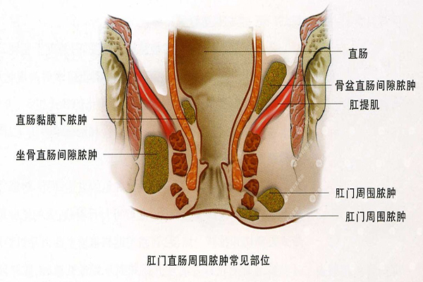 肛周膿腫_肛周膿腫圖片_肛周膿腫怎麼治療