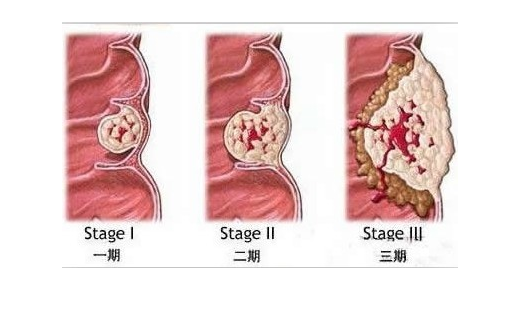 痔瘡如何消腫