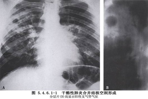 肺結核的傳播途徑主要是什麼？