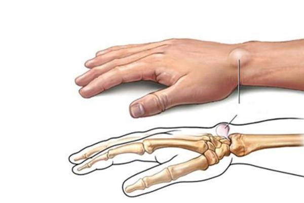 手腕腱鞘囊腫 腱鞘囊腫的治療