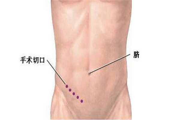 闌尾炎在哪邊 闌尾炎的癥狀