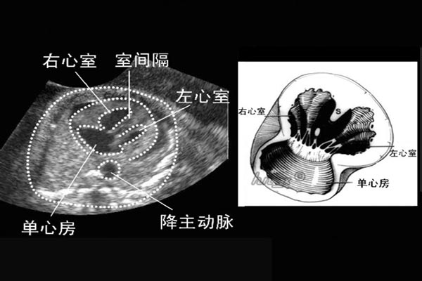 單心房是什麼 單心房的癥狀及治療