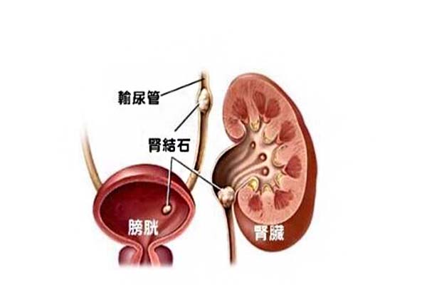 腎結石的癥狀有哪些_怎樣緩解腎結石疼痛_自然療法_病因