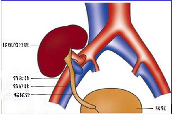 腎移植配型_腎移植後能活多久